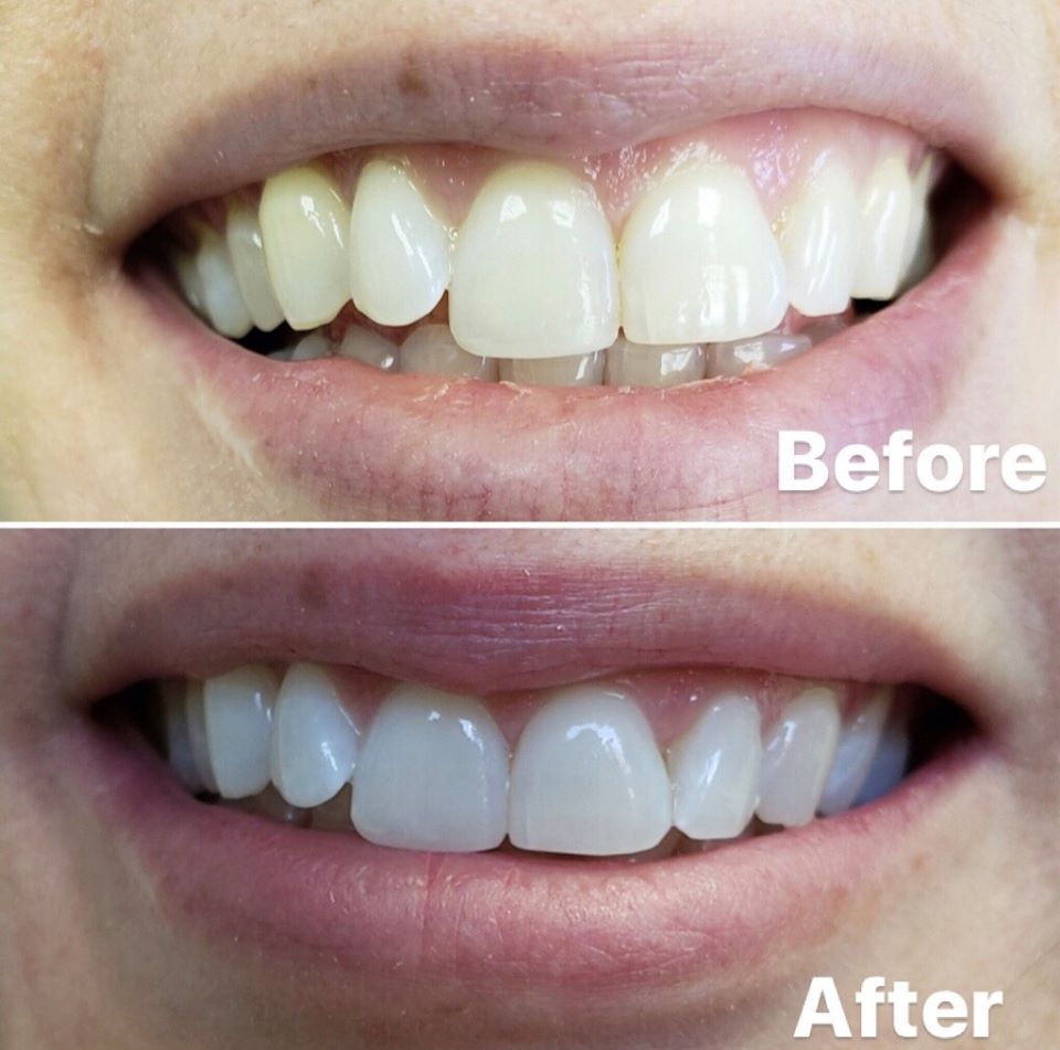 Teeth Whitening Adelaide - Adelaide Dental