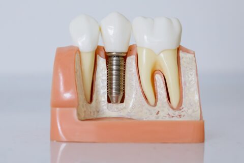 Implants, dentures and appliances