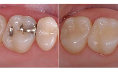 Teeth Restoration / Fillings